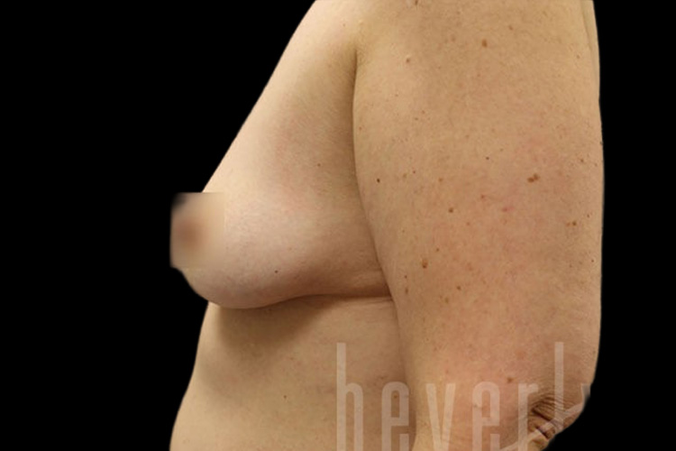 Case--8408 | Before Fat Transfer to Breasts 5