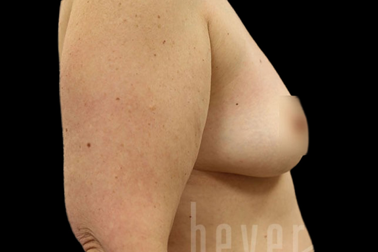 Case--8408 | Before Fat Transfer to Breasts 4