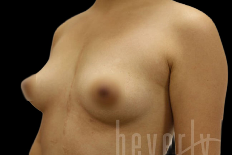 Case--7468 | Before Fat Transfer to Breasts 3