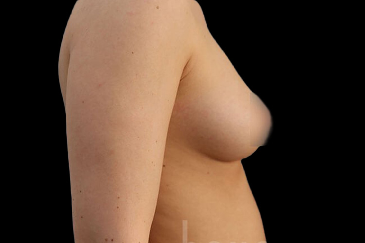 Case--7124 | Before Fat Transfer to Breasts 4