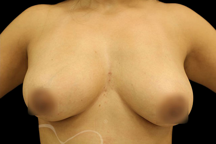 Case--2525 | After Fat Transfer to Breasts