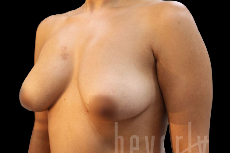 Case--2525 | Before Fat Transfer to Breasts 3