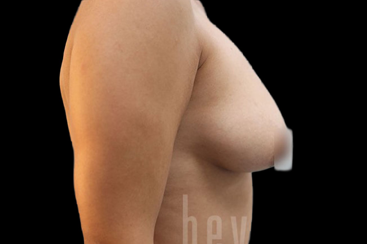 Case--2525 | Before Fat Transfer to Breasts 4