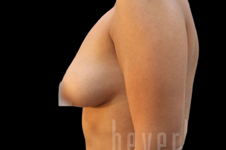 Case--2525 | Before Fat Transfer to Breasts 5