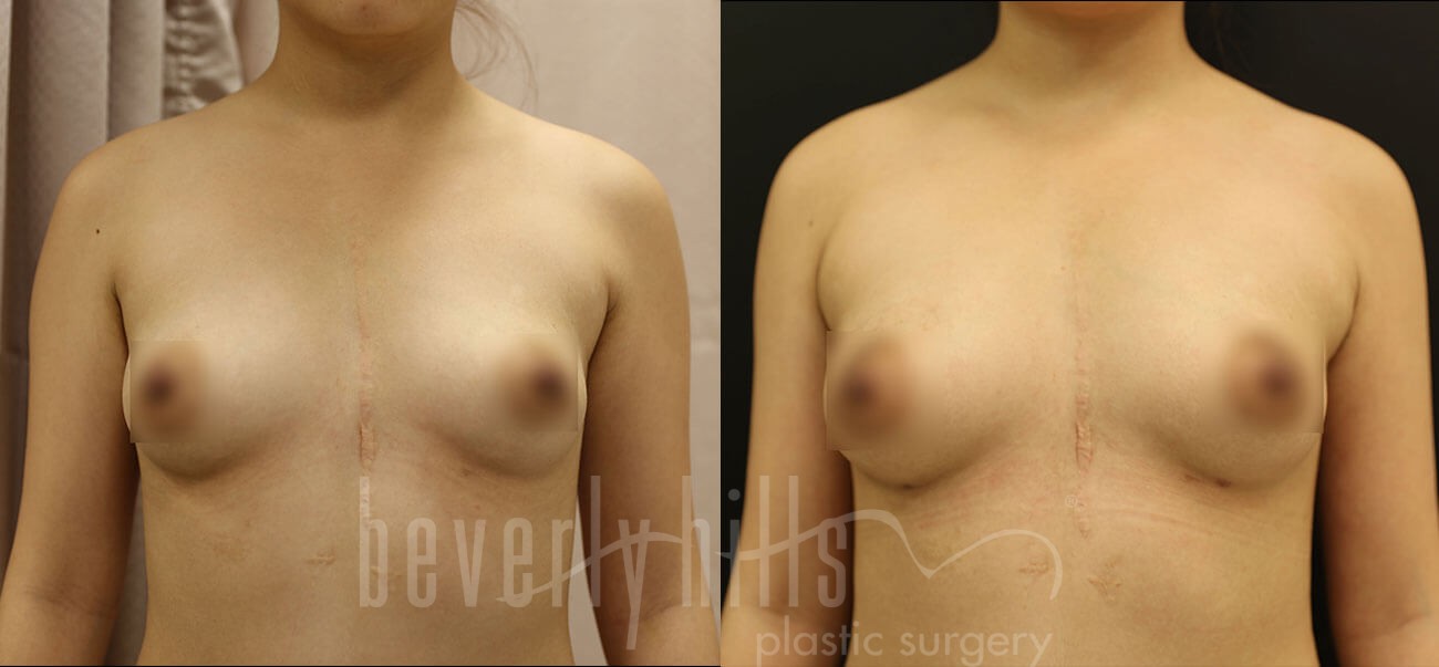 Fat Transfer Patient 01 Before & After