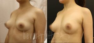 Fat Transfer Patient 01 Before & After - Thumbnail