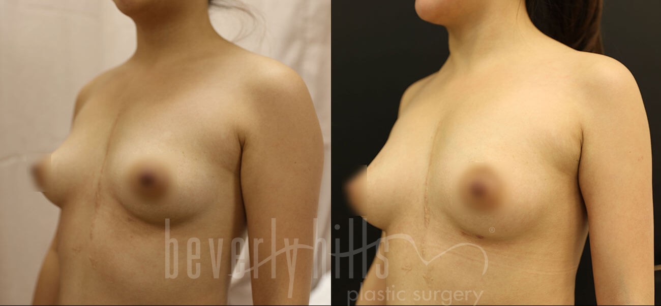 Fat Transfer Patient 01 Before & After