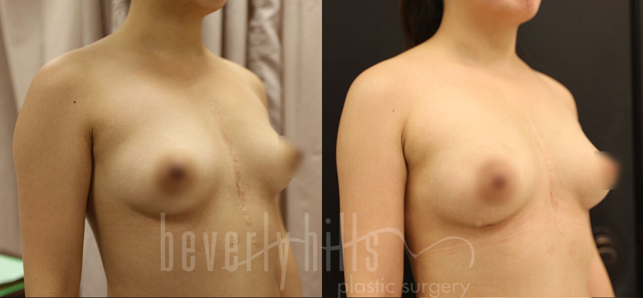 Fat Transfer Patient 01 Before & After