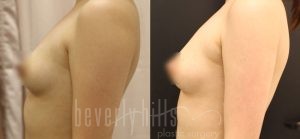 Fat Transfer Patient 01 Before & After - Thumbnail