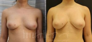 Fat Transfer Patient 02 Before & After - Thumbnail