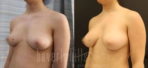 Fat Transfer Patient 02 Before & After - Thumbnail