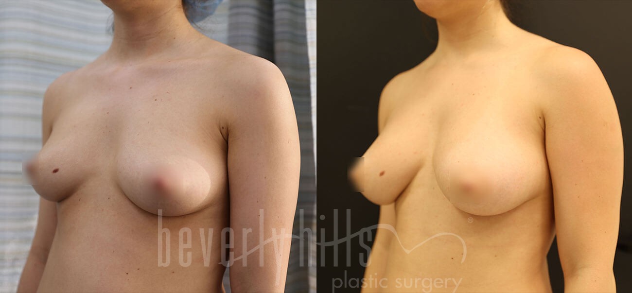 Fat Transfer Patient 02 Before & After