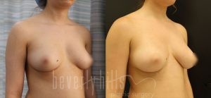 Fat Transfer Patient 02 Before & After - Thumbnail