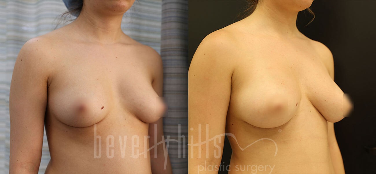 Fat Transfer Patient 02 Before & After