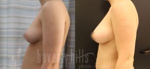 Fat Transfer Patient 02 Before & After - Thumbnail