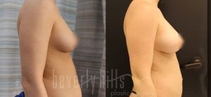 Fat Transfer Patient 02 Before & After - Thumbnail