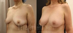 Fat Transfer Patient 03 Before & After - Thumbnail