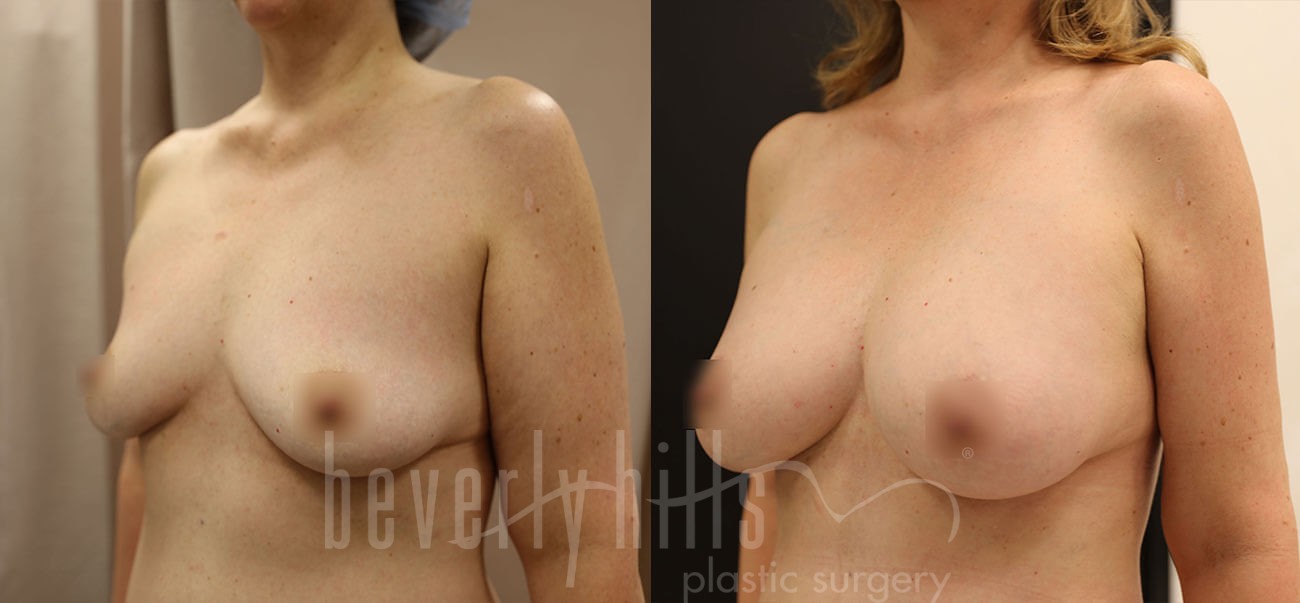 Fat Transfer Patient 03 Before & After