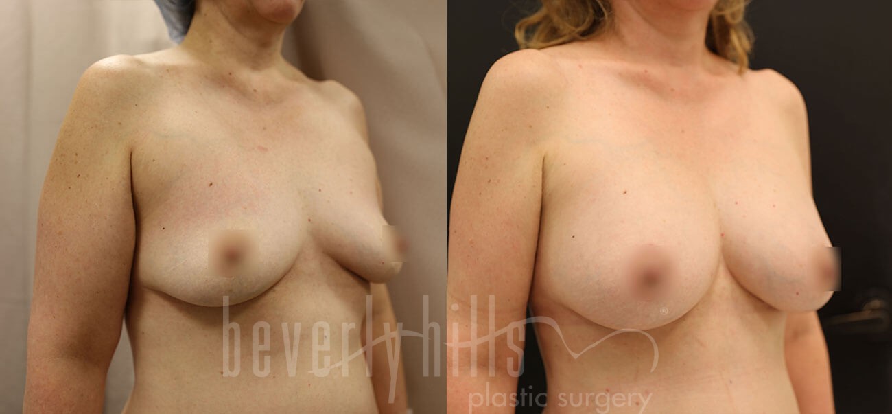 Fat Transfer Patient 03 Before & After