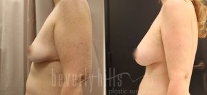 Fat Transfer Patient 03 Before & After - Thumbnail