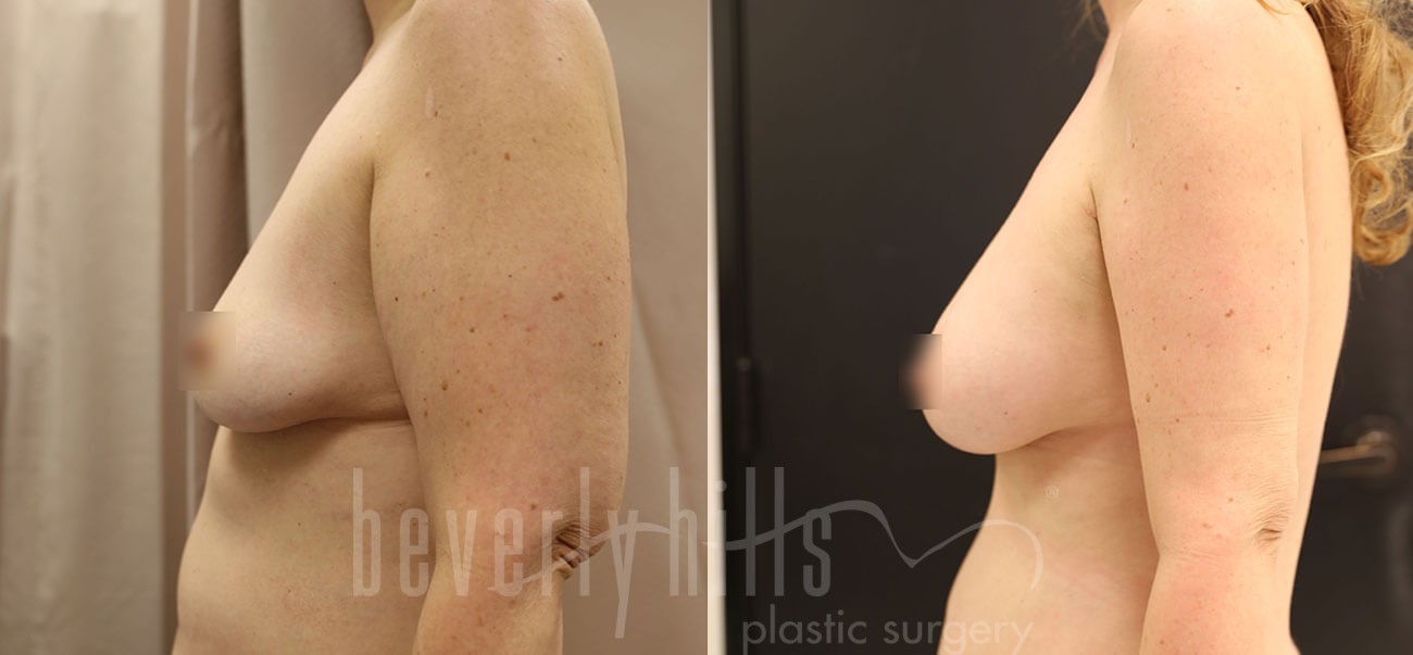 Fat Transfer Patient 03 Before & After