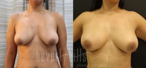 Fat Transfer Patient 04 Before & After - Thumbnail