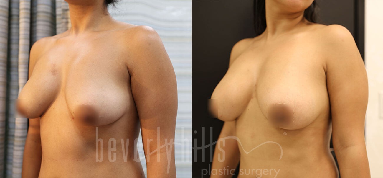 Fat Transfer Patient 04 Before & After