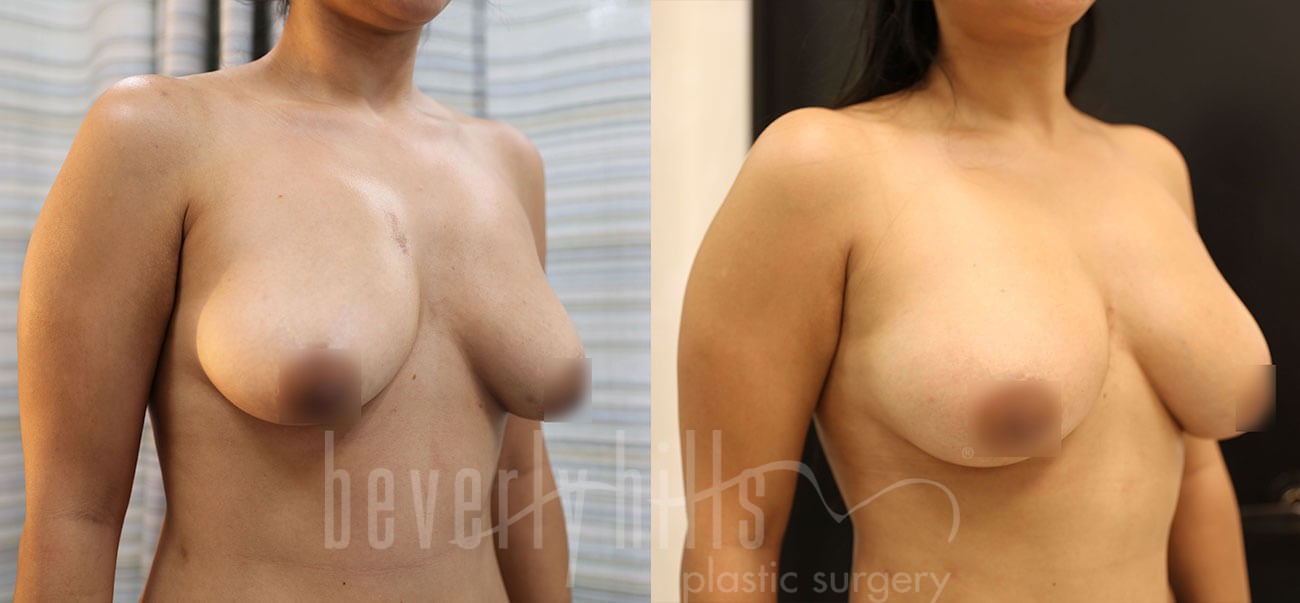 Fat Transfer Patient 04 Before & After