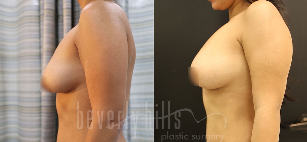 Fat Transfer Patient 04 Before & After