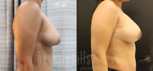 Fat Transfer Patient 04 Before & After - Thumbnail