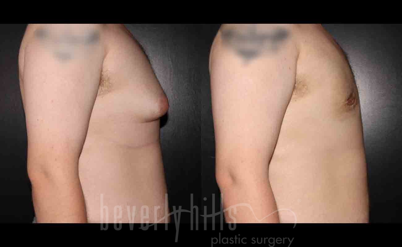 Gynecomastia patient 03 Before & After