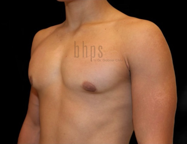 Gynecomastia Patient After - 2