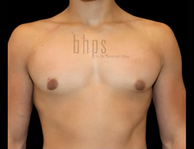 Gynecomastia Patient After - 1