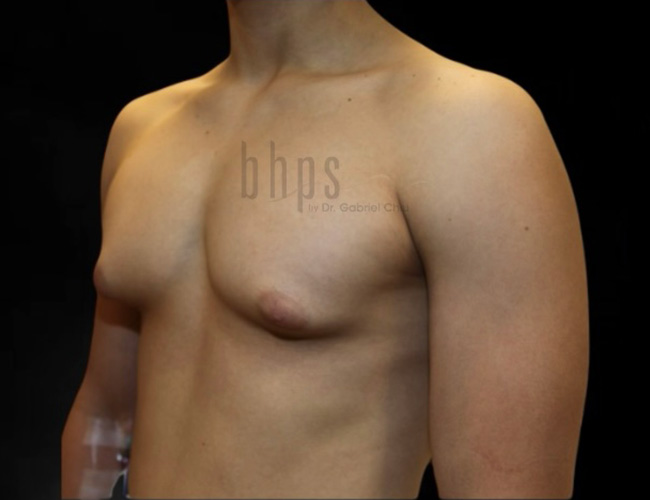 Gynecomastia Patient Before - 2
