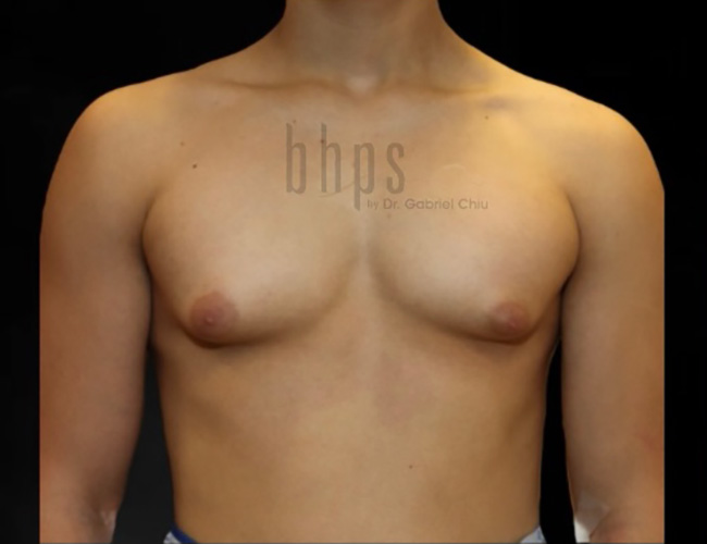 Gynecomastia Patient Before - 1