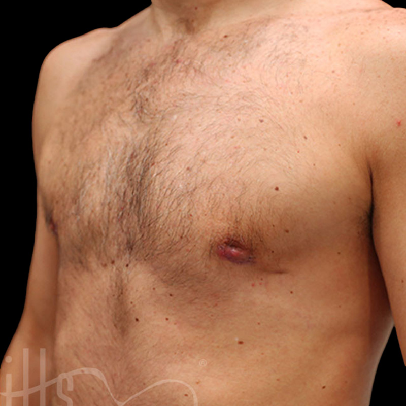 Case--3756 | After Gynecomastia 2
