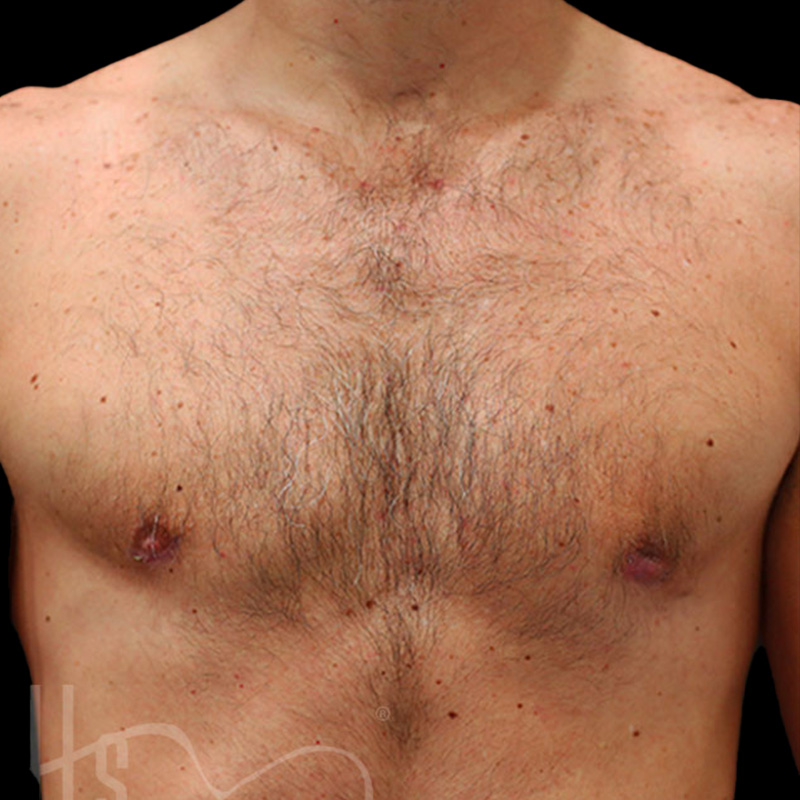 Case--3756 | After Gynecomastia