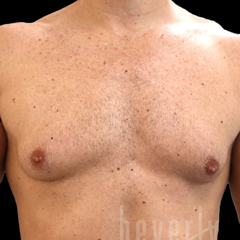 Case--3756 | Before Gynecomastia