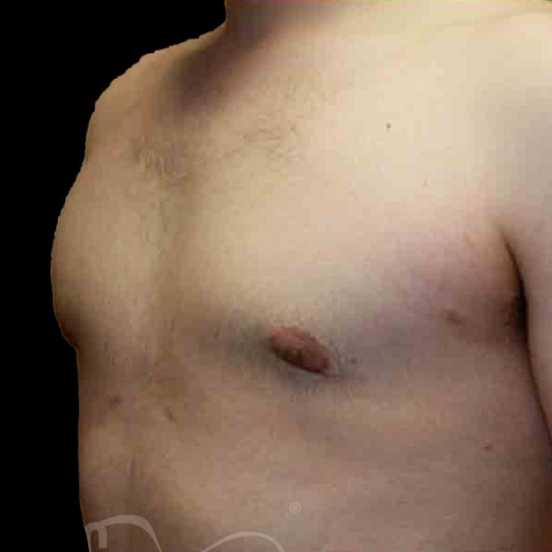 Case--7071 | After Gynecomastia 2