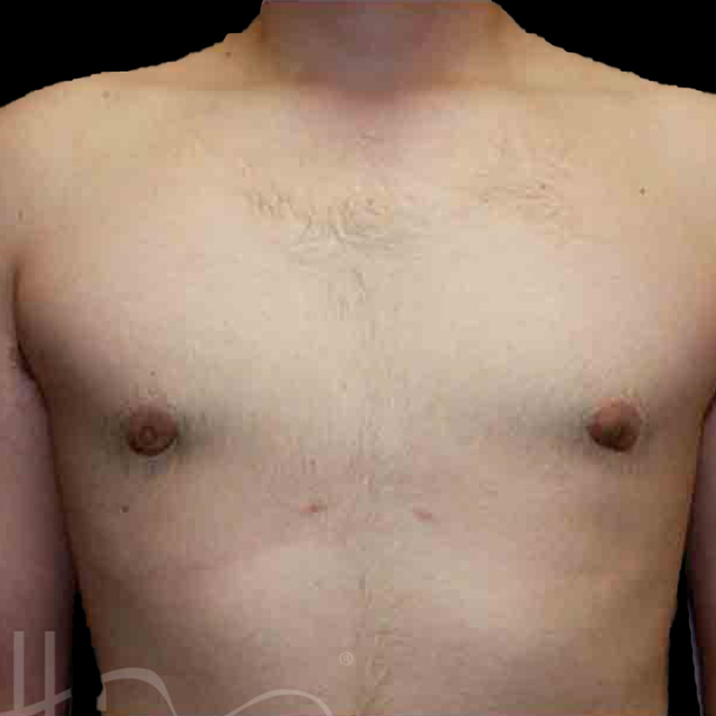 Case--7071 | After Gynecomastia