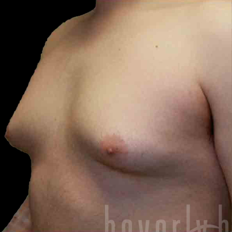 Case--7071 | Before Gynecomastia 2