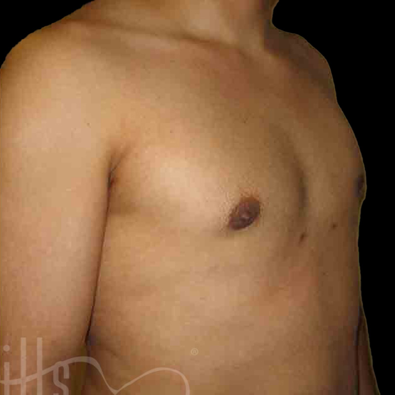 Case--1353 | After Gynecomastia