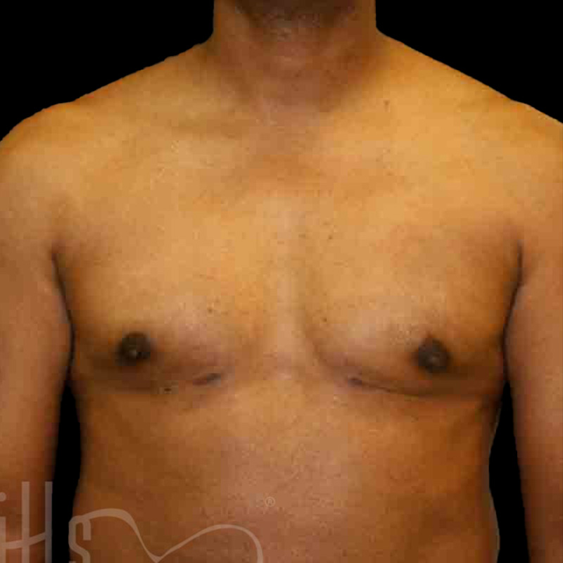 Case--4025 | After Gynecomastia