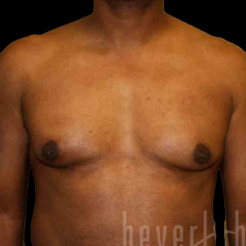 Case--4025 | Before Gynecomastia