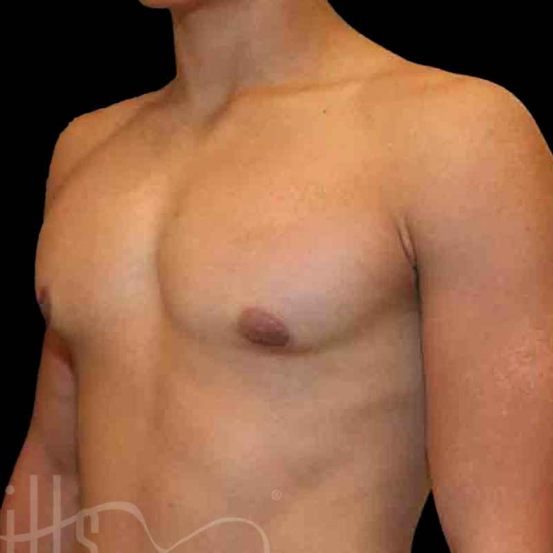 Case--6703 | After Gynecomastia