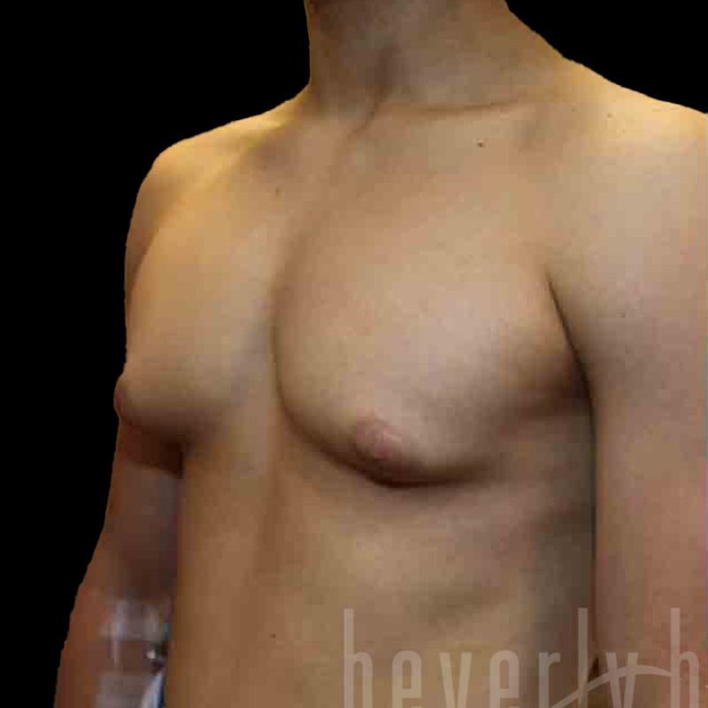 Case--6703 | Before Gynecomastia