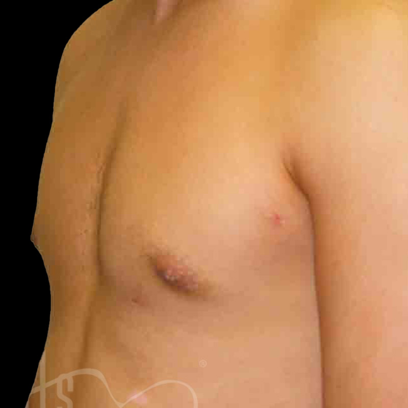 Case--7737 | After Gynecomastia