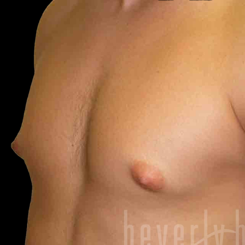 Case--7737 | Before Gynecomastia