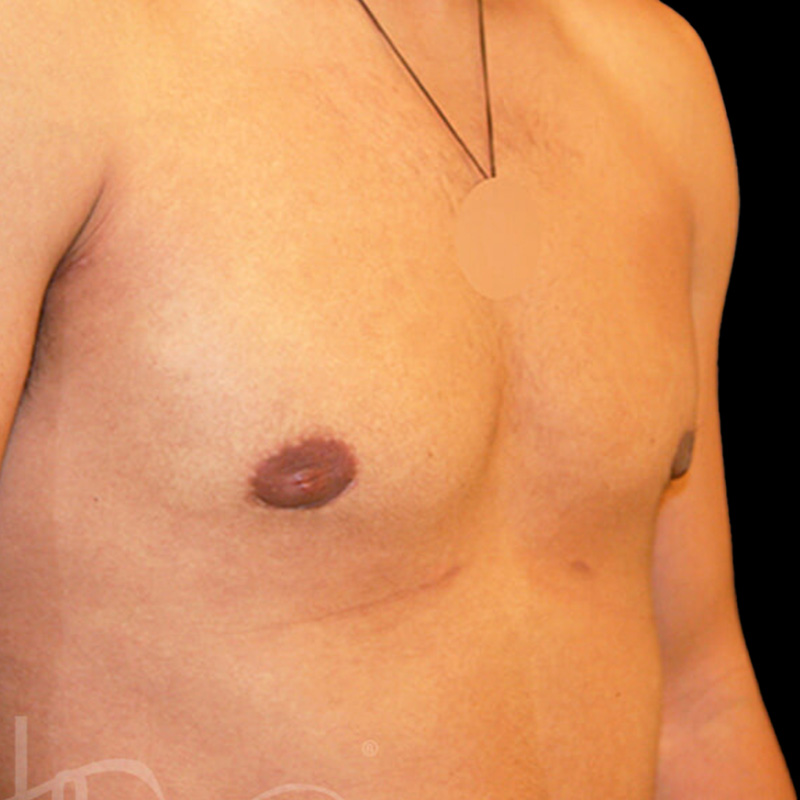 Case--9487 | After Gynecomastia 2