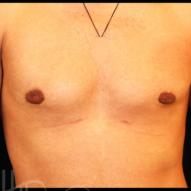 Case--9487 | After Gynecomastia